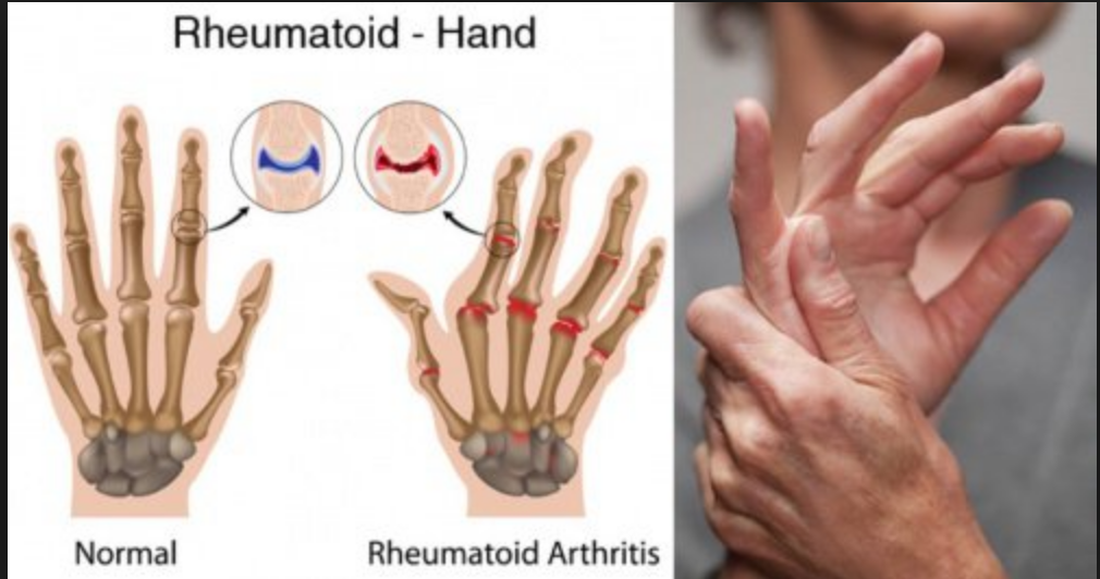  Rheumatoid Arthritis